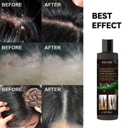 EELHOE Anti-Dandruff Shampoo - Itch Relief, Hair Loss Prevention, Oil Control &amp; Refreshing Care